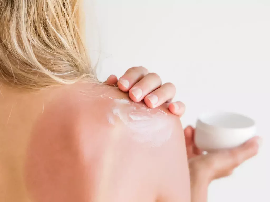 6 Home Remedies for Sunburn