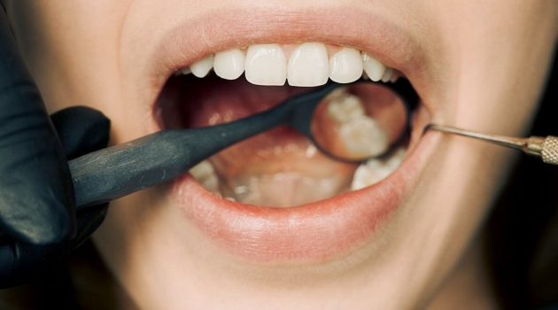 dentist checking teeth of a person